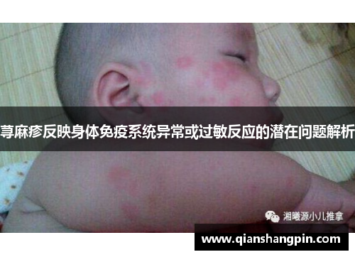 荨麻疹反映身体免疫系统异常或过敏反应的潜在问题解析